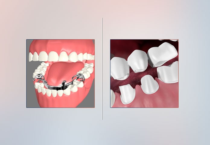 Dentures or Dental Bridges: Which One to Pick?