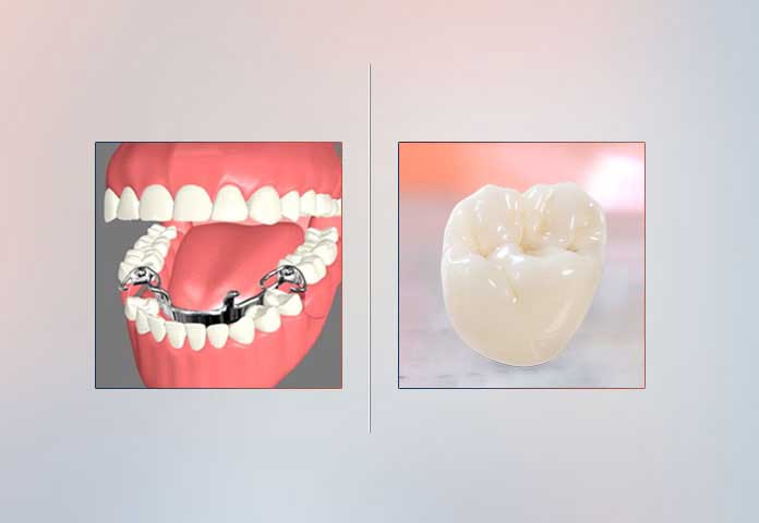 Dentures Vs. Porcelain Dental Crowns | Cary and Apex NC
