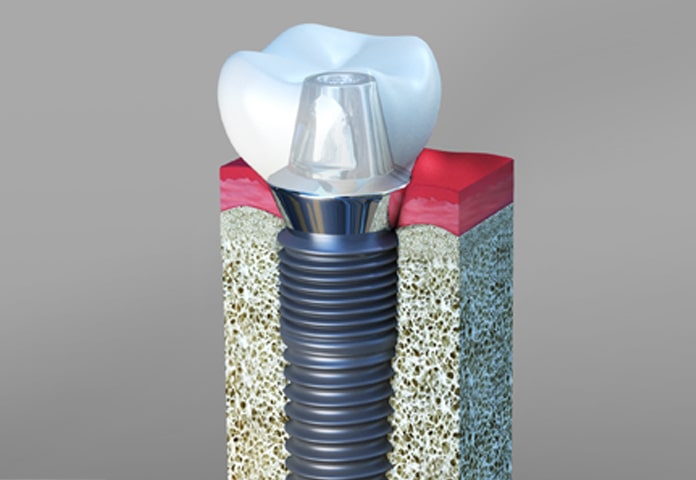 Osseointegration – The key to dental implant surgery