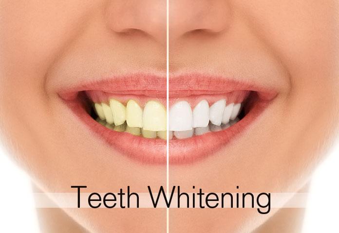 Teeth Whitening: The Most Favoured Method For Cosmetic Dentists In Apex And Cary